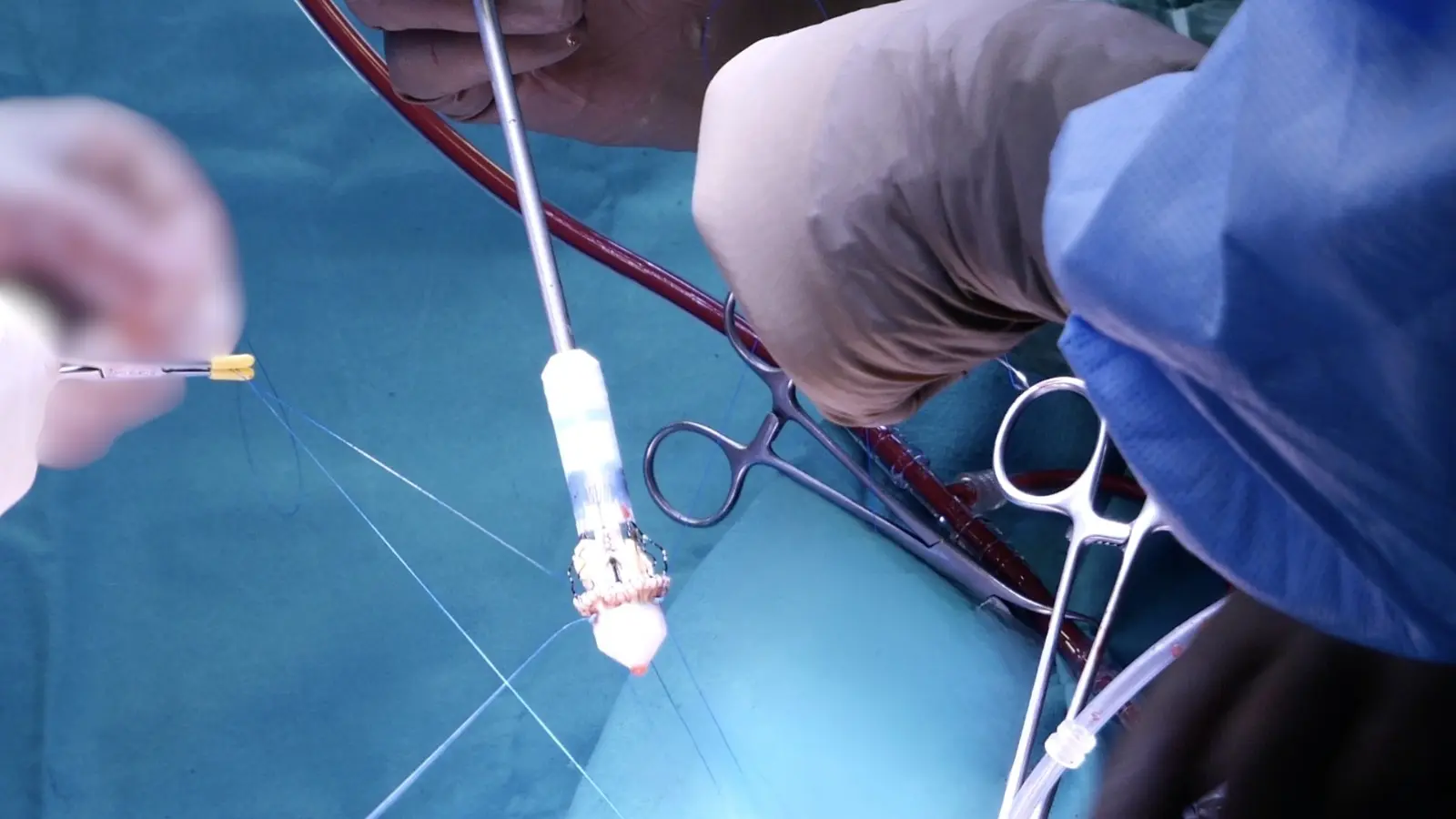 Kapalı Mitral Kapak Cerrahisi